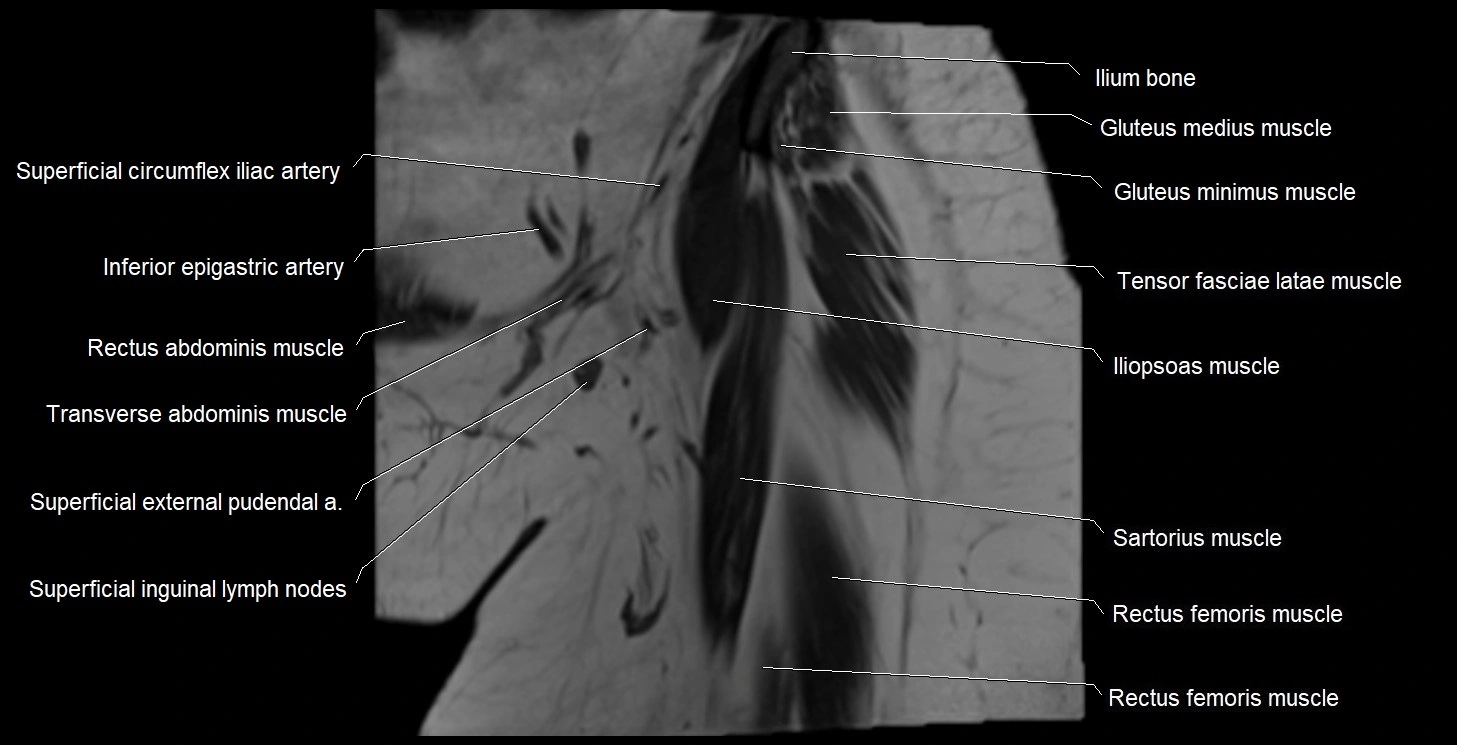 MRI Hip 3T coronal cross sectional anatomy image 4.webp